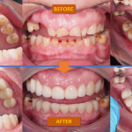CH Before and After Mouth