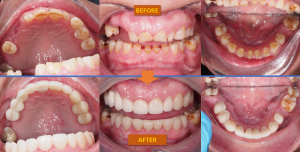 CH Before and After Mouth