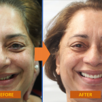 CH Face Before and After