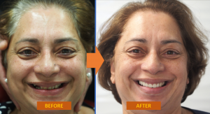 CH Face Before and After