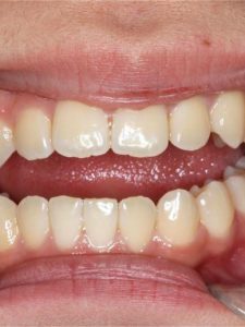 Before Jaw Repositioning (Orthognathic) Surgery