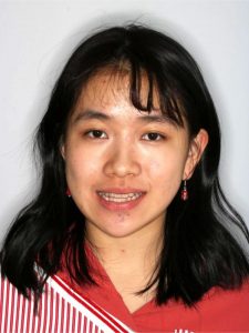 Before Jaw Repositioning (Orthognathic) Surgery Before Jaw Repositioning (Orthognathic) Surgery