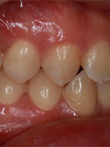 After Jaw Repositioning (Orthognathic) Surgery