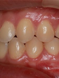 After Jaw Repositioning (Orthognathic) Surgery