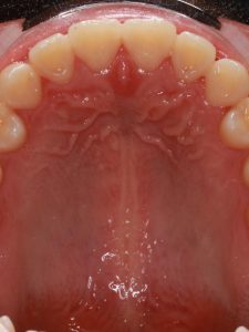 After Jaw Repositioning (Orthognathic) Surgery