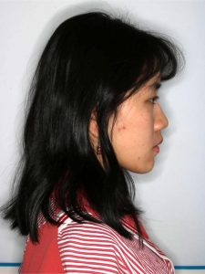Before Jaw Repositioning (Orthognathic) Surgery Before Jaw Repositioning (Orthognathic) Surgery