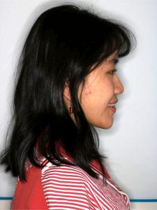 Before Jaw Repositioning (Orthognathic) Surgery Before Jaw Repositioning (Orthognathic) Surgery