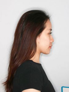 After Jaw Repositioning (Orthognathic) Surgery After Jaw Repositioning (Orthognathic) Surgery