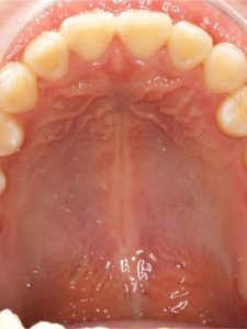 Before Jaw Repositioning (Orthognathic) Surgery