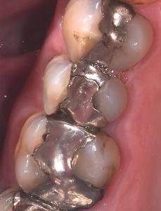 After-Fixing-Cracks-And-Splits-Within-Teeth-Case-Study-eDentistry-Wantirna