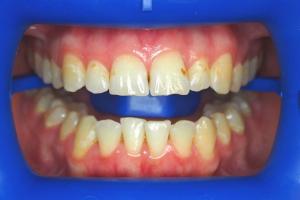 After-Getting-Rid-Of-Brown-Discoloured-Marks-On-Teeth-With-Whitening-Case-Study-eDentistry-Wantirna