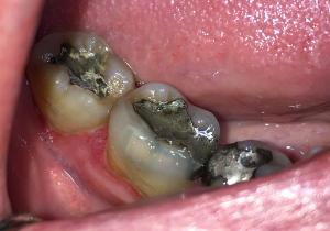 After-Treating-Large-Lumps-In-The-Gums-Case-Study-eDentistry-Wantirna