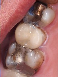 Before-Fixing-Cracks-And-Splits-Within-Teeth-Case-Study-eDentistry-Wantirna