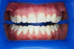 Before-Getting-Rid-Of-Brown-Discoloured-Marks-On-Teeth-With-Whitening-Case-Study-eDentistry-Wantirna