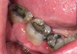 Before-Treating-Large-Lumps-In-The-Gums-Case-Study-eDentistry-Wantirna