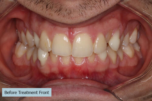Before Treatment Front 