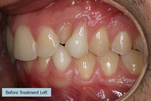 Before Treatment Left