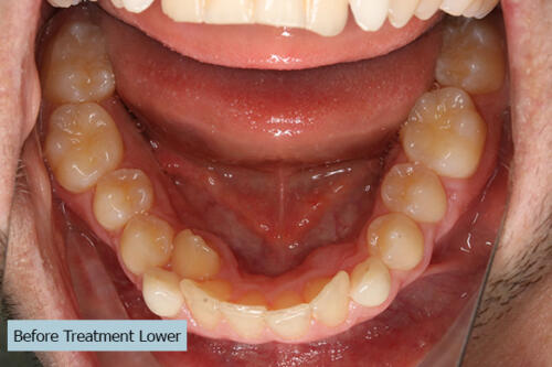 Before Treatment Lower