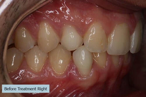 Before Treatment Right