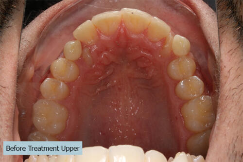 Before Treatment Upper