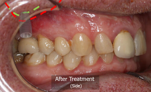 Photo Side View (After)