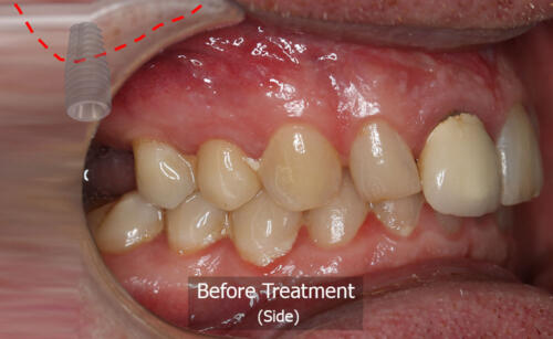 Photo Side View (Before)