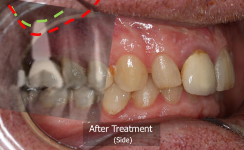 Photo Side View with X-ray overlay (after)