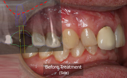 Photo Side View with X-ray overlay (before)