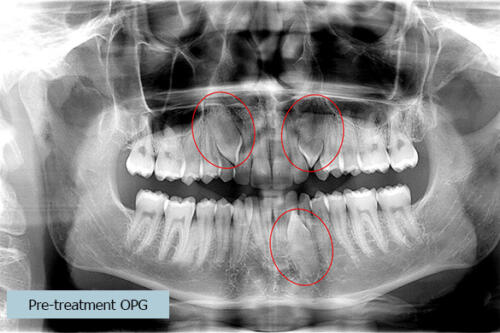 Pre treatment OPG red circles