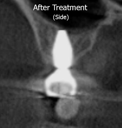 X-ray Cross Section View (After)