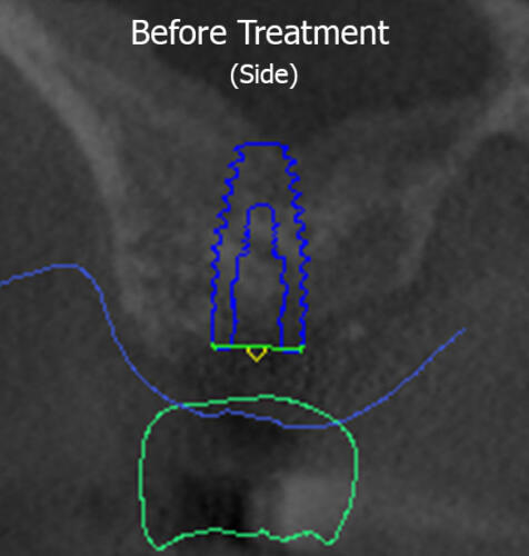 X-ray Cross Section View (Before)