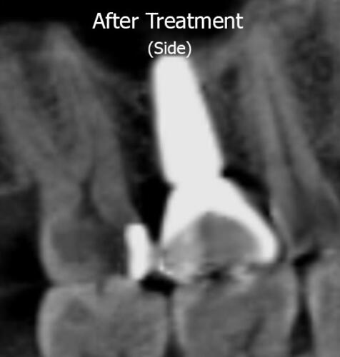 X-ray Side View (After)