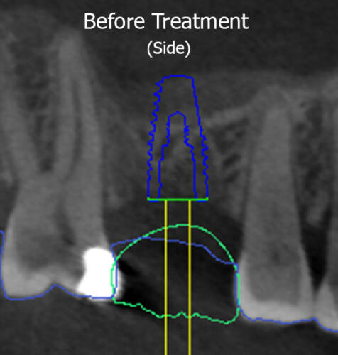X-ray Side View (Before)