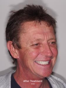 After Treatment from the Side