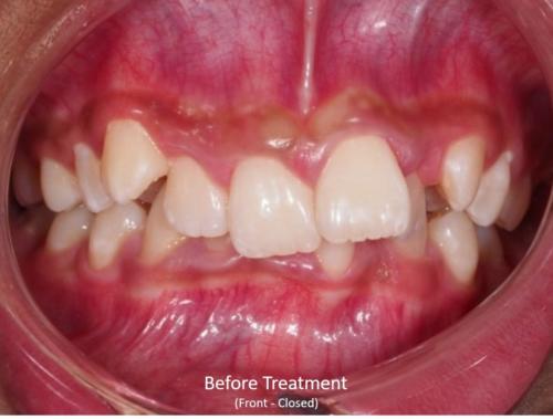 Before - Front (Closed)