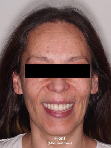 Frontal View of the Face - After Treatment