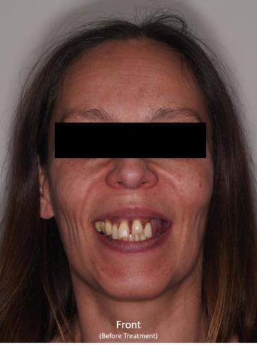 Frontal View of the Face - Before Treatment