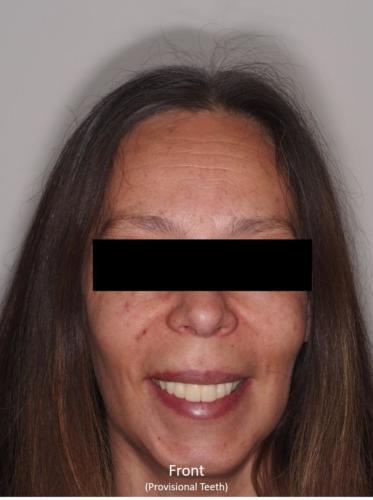 Frontal View of the Face - With Provisional