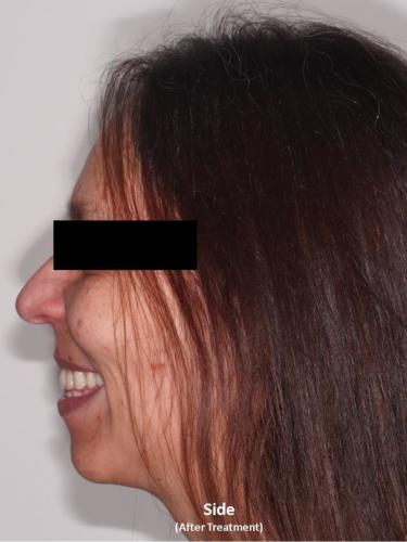Side View of the Face - After Treatment