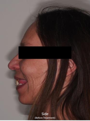 Side View of the Face - Before Treatment
