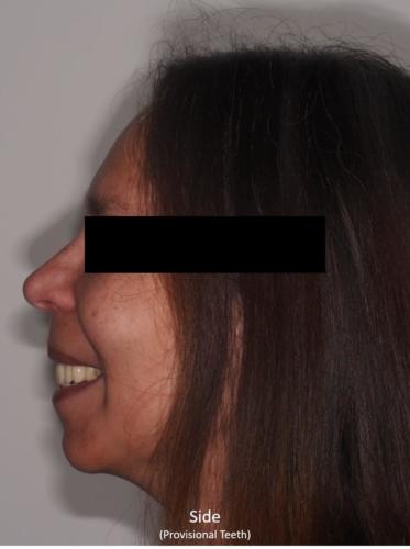 Side View of the Face - With Provisional