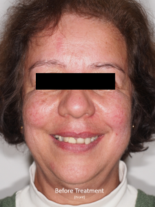 JF Front Before Face